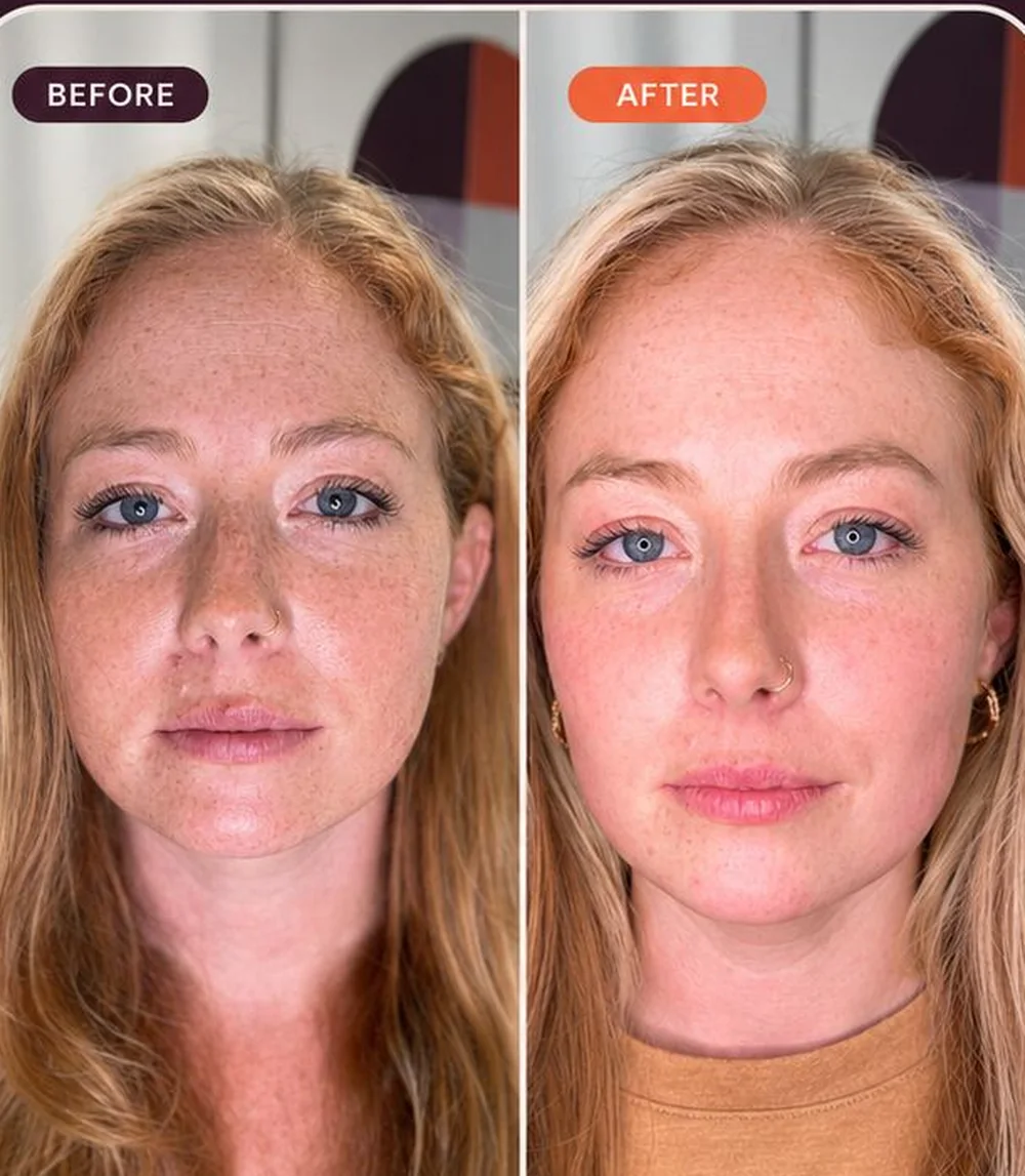 Real TriLift facial treatment results